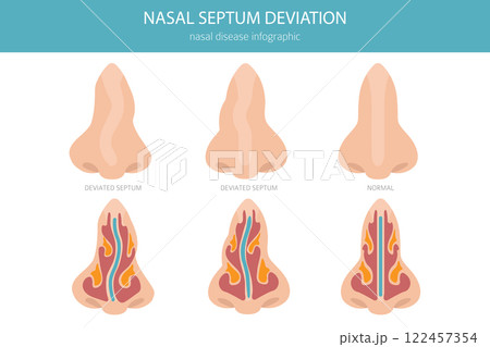 Nose Deviated Septum. Nasal diseases. Medical infographic design Nose Deviated Septum. Nasal diseases. Medical infographic design 122457354