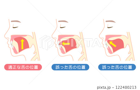 適正な舌の位置と誤った舌の位置 ミューイング 適正な舌の位置と誤った舌の位置 ミューイング 122480213