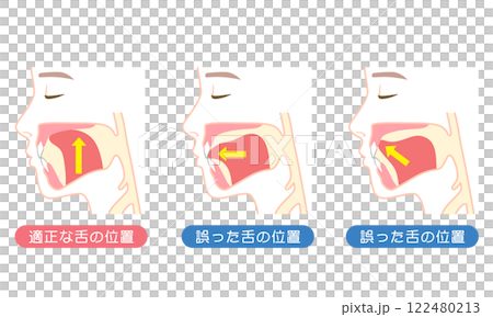 適正な舌の位置と誤った舌の位置 ミューイング 適正な舌の位置と誤った舌の位置 ミューイング 122480213