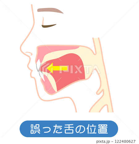 誤った舌の位置　下がっている舌の位置 122480627
