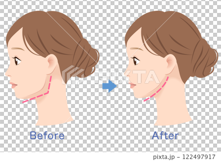 Profile of a woman with a prominent jawline: before and after Profile of a woman with a prominent jawline: before and after 122497917