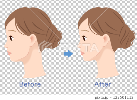 エラの張った女性の横顔 ビフォーアフター エラの張った女性の横顔 ビフォーアフター 122501112