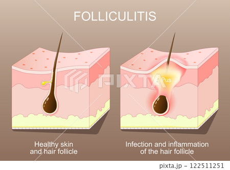 Folliculitis. Healthy skin before and after Infection and inflammation of the hair follicle. Acne 122511251