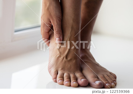 Woman gently touching her foot with large swollen veins.  122539366