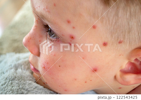 Natural vaccination. Contagious disease. Sick child with chickenpox. Varicella virus or Chickenpox bubble rash on child body and face. High quality photo 122543425