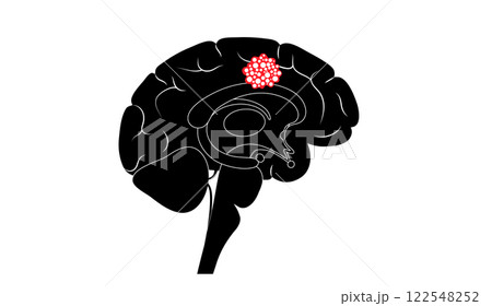 Brain cancer poster 122548252