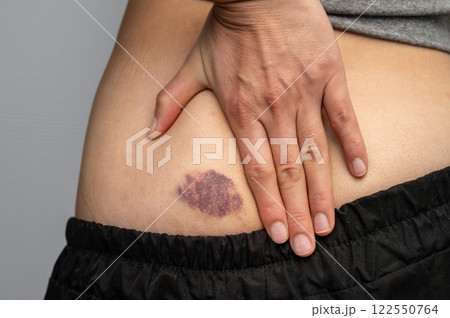 Cropped shot view of woman having bruised on her butt. Bruises happen when small blood vessels in the skin are damaged. 122550764