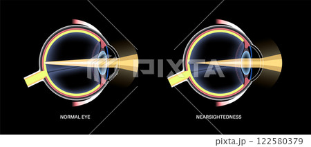 Normal eye and nearsightedness Normal eye and nearsightedness 122580379