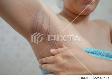 Problem black armpit of pregnant women for skin care and beauty concept 122589573