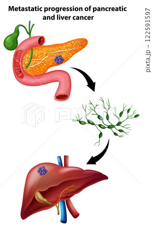 Metastatic Progression of Pancreatic Cancer 122591597