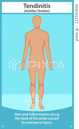 Achilles Tendonitis Illustration Achilles Tendonitis Illustration 122591608