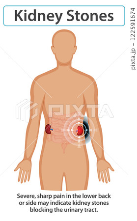 Understanding Kidney Stones and Symptoms Understanding Kidney Stones and Symptoms 122591674