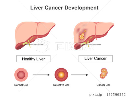 Liver cancer is caused by genetic mutation 122596352
