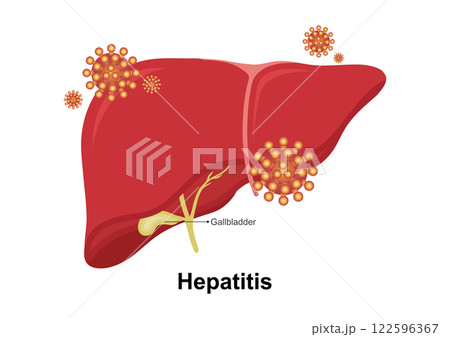 Hepatitis is an inflammation of the liver. 122596367