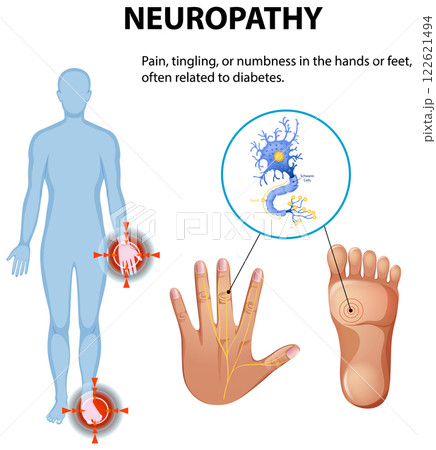 Understanding Neuropathy and Its Symptoms 122621494