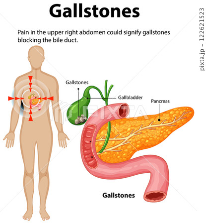 Understanding Gallstones and Their Effects 122621523