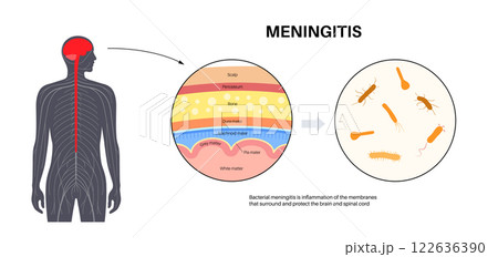 Meningitis medical poster Meningitis medical poster 122636390