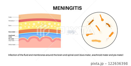 Meningitis medical poster Meningitis medical poster 122636398
