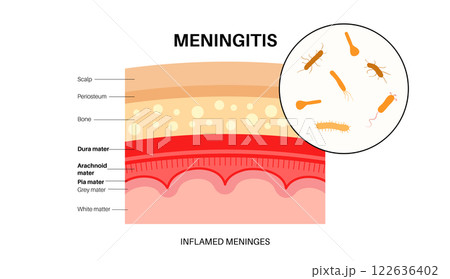 Meningitis medical poster 122636402