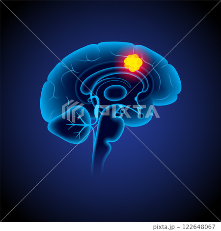 Brain cancer poster Brain cancer poster 122648067