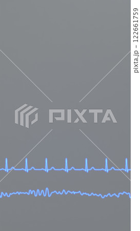 Normal heart rhythm ECG and ventricular fibrillation Normal heart rhythm ECG and ventricular fibrillation 122661759