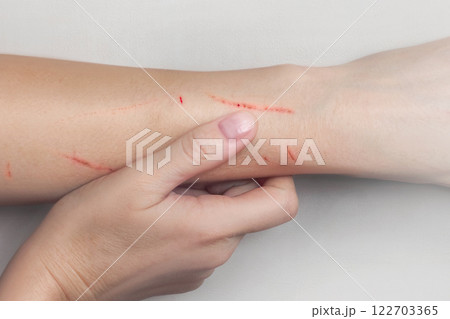 Scratches on the woman's hand. Scratches from cat, dog, beast, falls close up 122703365