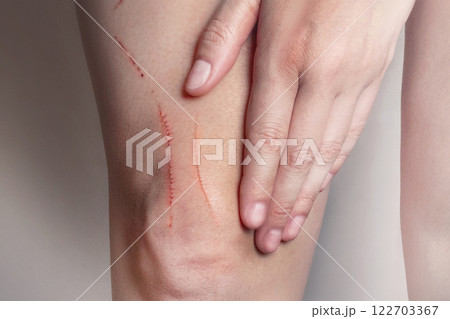 Scratches on the woman's leg. Scratches from cat, dog, beast, falls close up Scratches on the woman's leg. Scratches from cat, dog, beast, falls close up 122703367