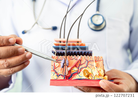 Hair transplant, Asian dermatologist doctor holding skin structure anatomy model for treatment in hospital. Hair transplant, Asian dermatologist doctor holding skin structure anatomy model for treatment in hospital. 122707231