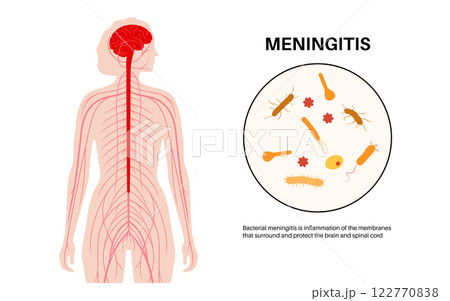Meningitis medical poster 122770838