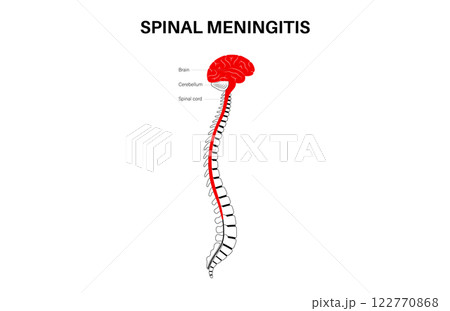 Spinal meningitis poster Spinal meningitis poster 122770868