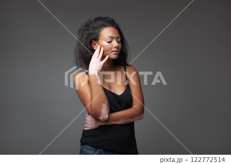 Sensuous fashion model with vitiligo posing Sensuous fashion model with vitiligo posing 122772514