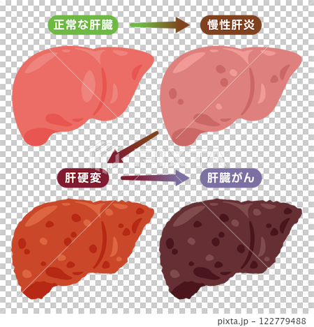 肝臓がんになる過程イラスト 122779488