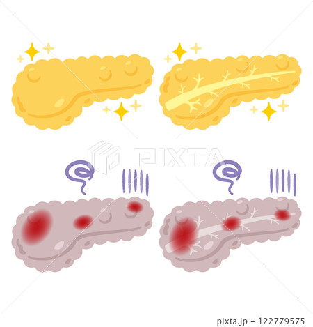 健康でキレイな膵臓と炎症が起きた不健康な膵臓のイラスト 122779575
