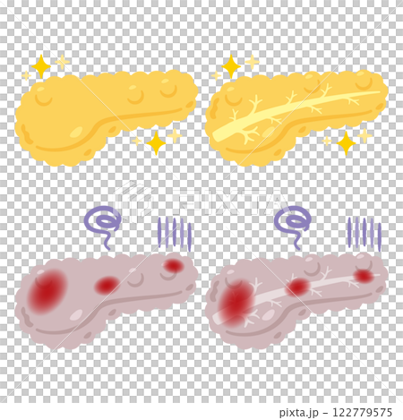 健康でキレイな膵臓と炎症が起きた不健康な膵臓のイラスト 122779575