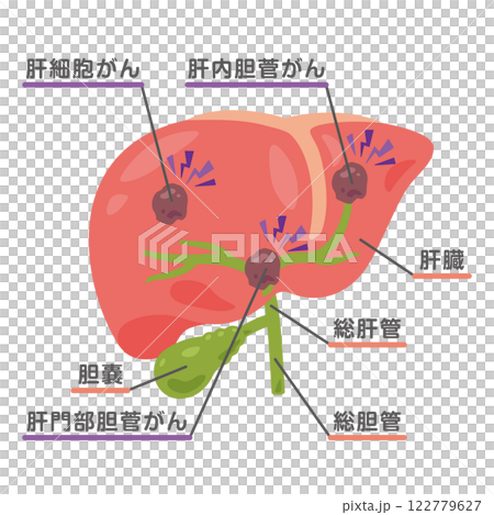肝臓がんになった肝臓のイラスト1 肝臓がんになった肝臓のイラスト1 122779627
