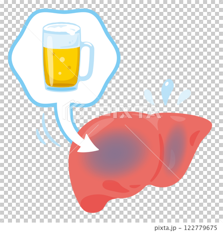 Illustration of liver damaged by alcohol 122779675