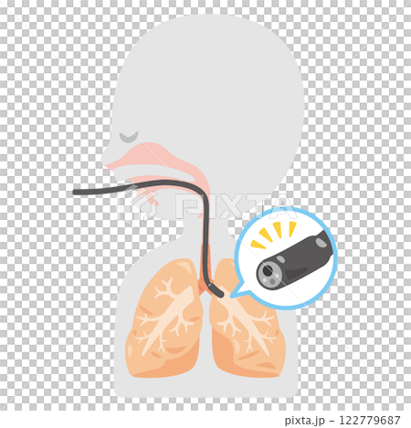 A simple profile illustration of a person undergoing a bronchoscopy 122779687