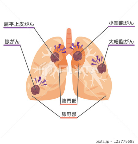 肺がんになった肺のイラスト1 122779688