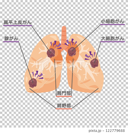 Illustration of a lung with lung cancer 1 122779688