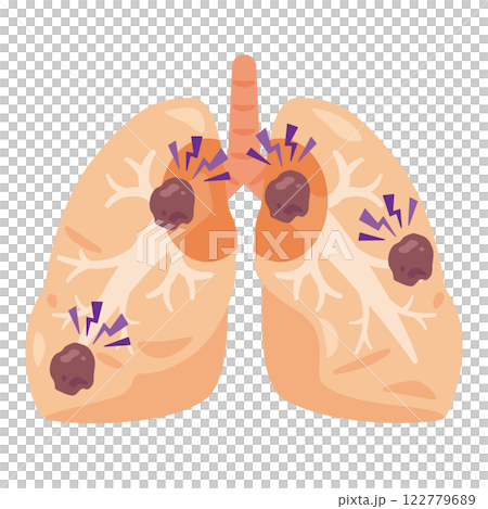 肺癌肺部圖示 2 122779689