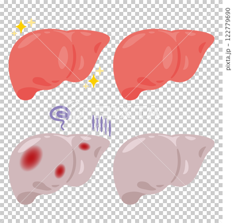 Illustration of a healthy and clean liver and an inflamed unhealthy liver 122779690