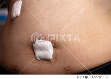 Surgical dressing on the abdomen of a man who underwent laparoscopic Surgical dressing on the abdomen of a man who underwent laparoscopic 122785820