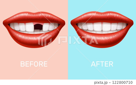 Woman mouth without tooth. Teeth implantation. Realistic woman mouth, smile before and after. Prosthetics in stomatology clinic. Dental medicine, molar 3d isolated vector healthcare concept 122800710