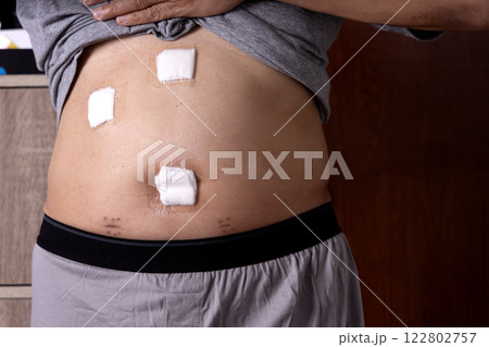 Surgical dressing on the abdomen of a man who underwent laparoscopic Surgical dressing on the abdomen of a man who underwent laparoscopic 122802757