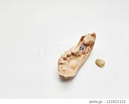 Implant Zirconia Crown Implant Zirconia Crown 122812122