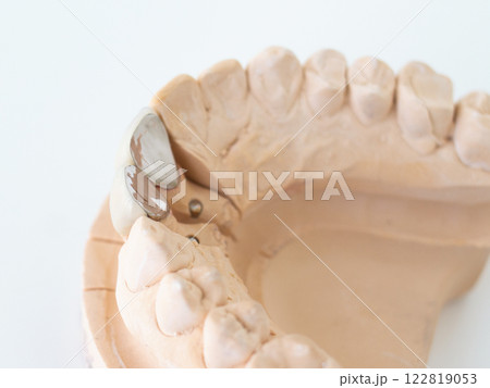 全装冠 前歯のクラウン 歯科 保険治療 模型つき 122819053