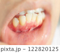 口内炎 歯科 治療 アフタ 症例 122820125