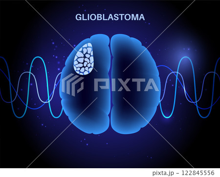 Glioblastoma brain cancer Glioblastoma brain cancer 122845556