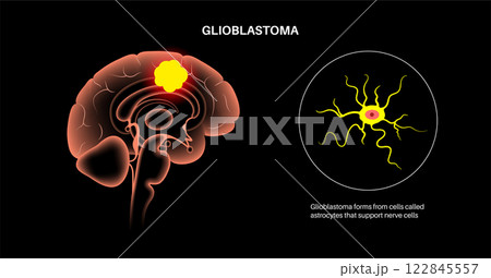 Glioblastoma brain cancer 122845557