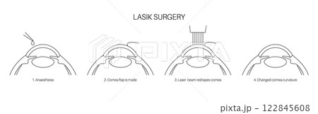 LASIK eye surgery 122845608